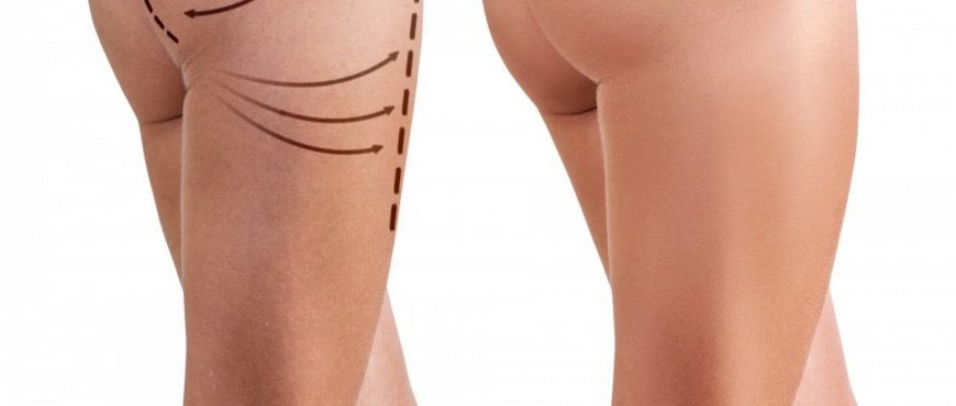 Piel de Naranja Plus
